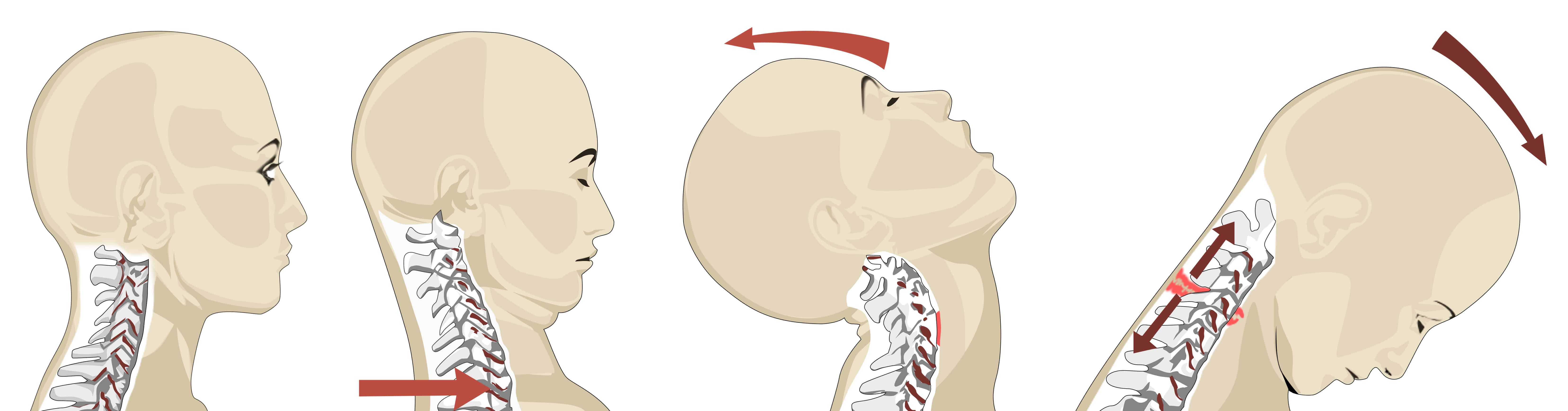 Whiplash Wright Physical Therapy